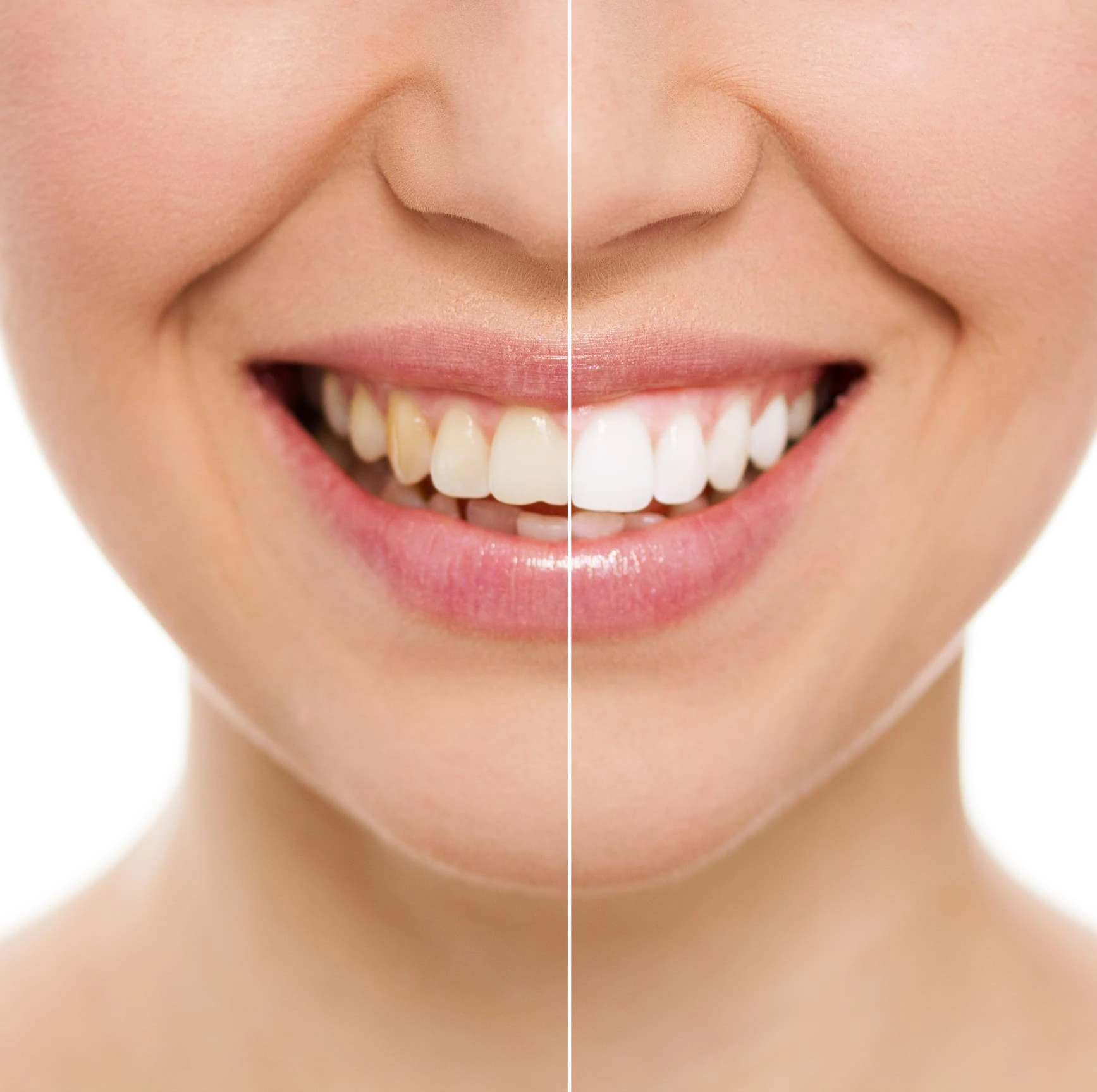 Clareamento Dental
