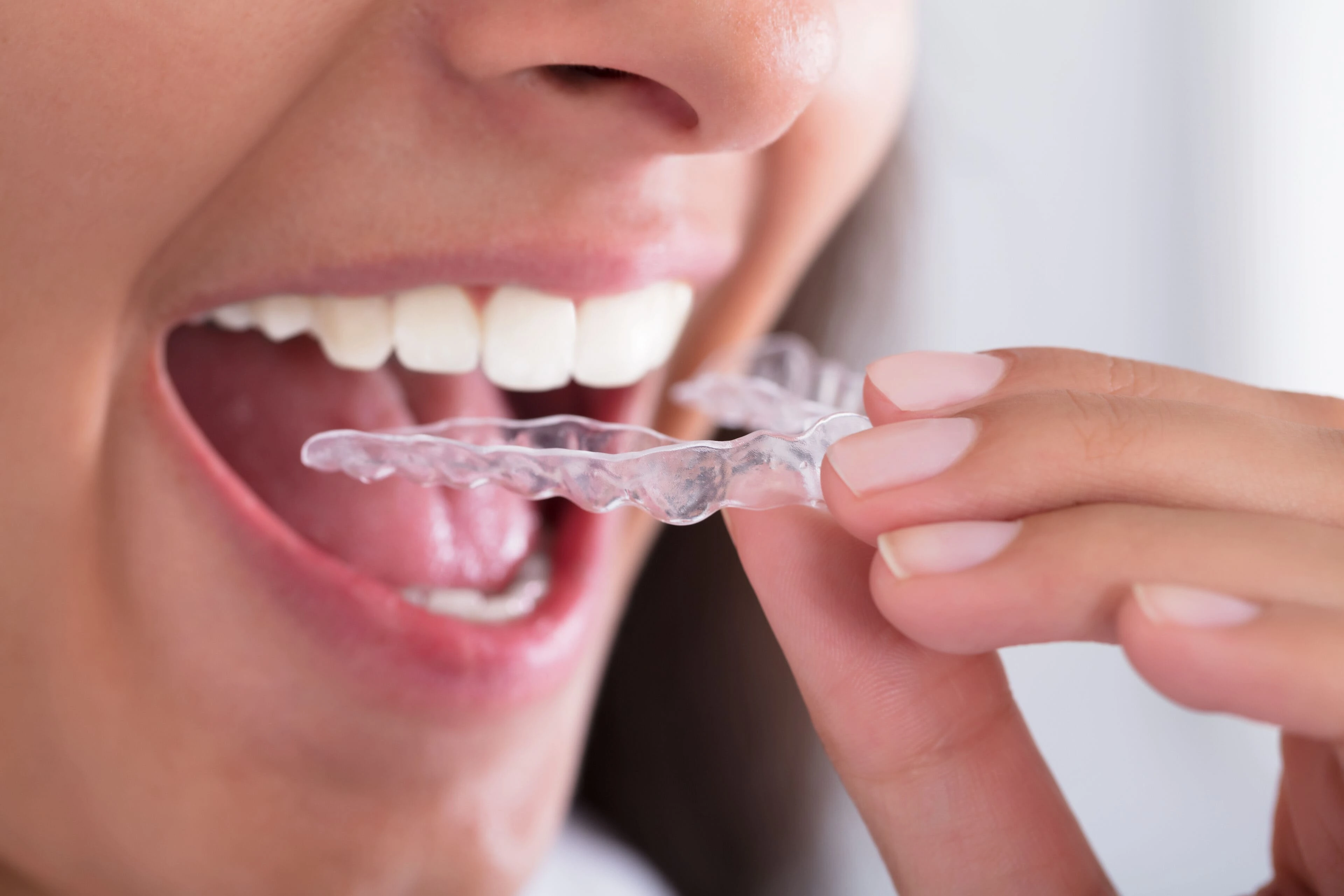 Paciente com placa oclusal